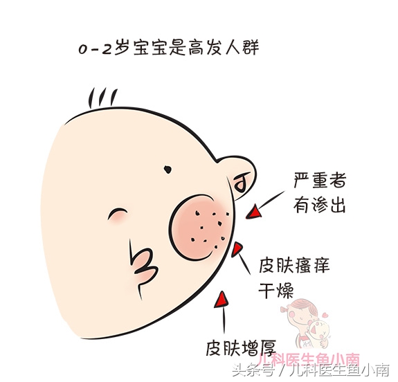 新生儿热疹和湿疹的预防与护理,宝宝湿疹热疹如何预防及护理