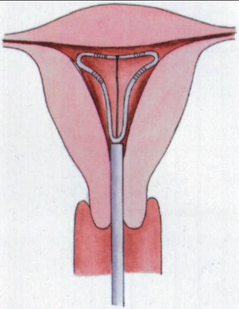 48岁月经紊乱出血不止,月经不止上曼月环继续出血怎么办