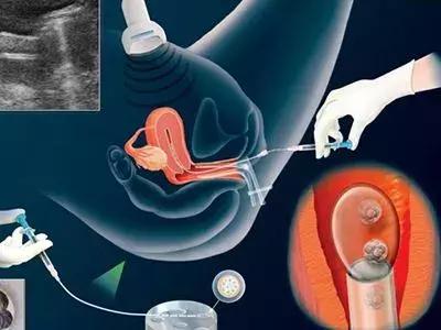 女大学生捐卵案完整,女大学生捐29个卵