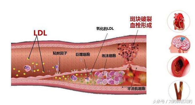 血脂化验中tc和tg各表示是什么,血脂化验脂蛋白a高