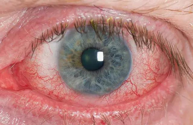 干眼症吃深海鱼油有用吗,干眼症深海鱼油