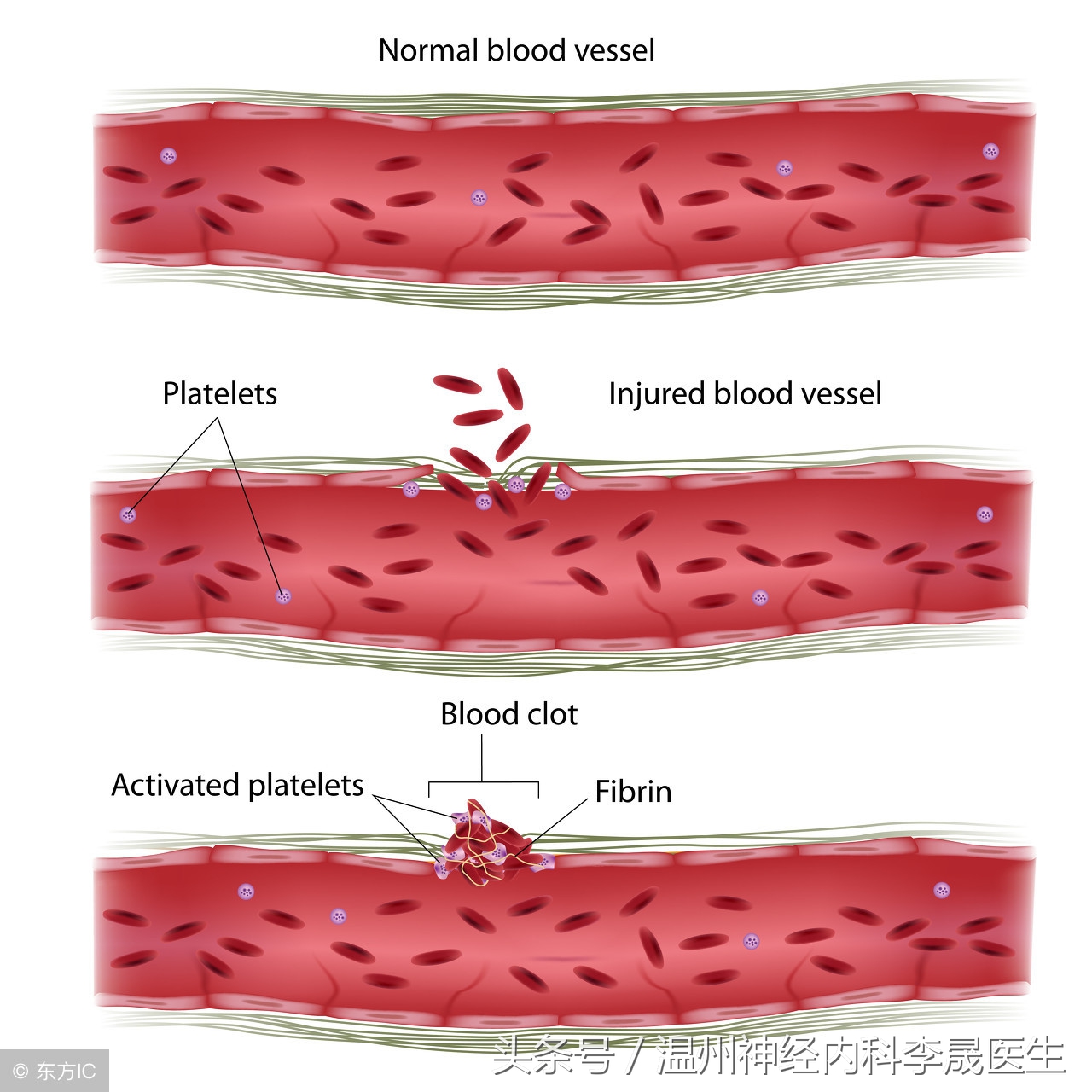 脑出血李医生,脑出血病例分析及答案