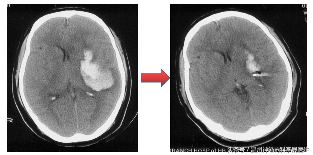 简述脑出血的内科治疗,脑出血中医解析