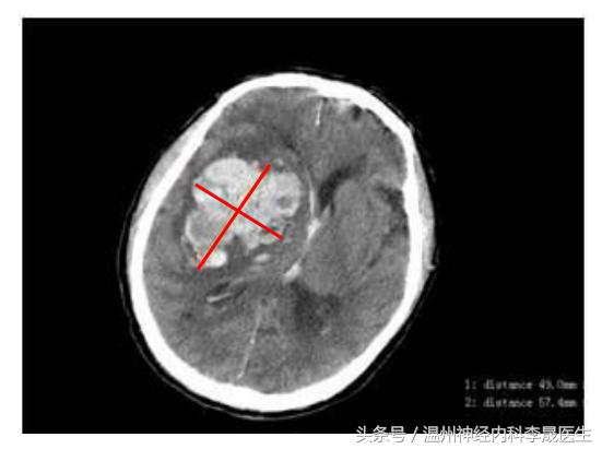 专家讲解中医治疗脑出血视频,医生对脑出血病人的治疗