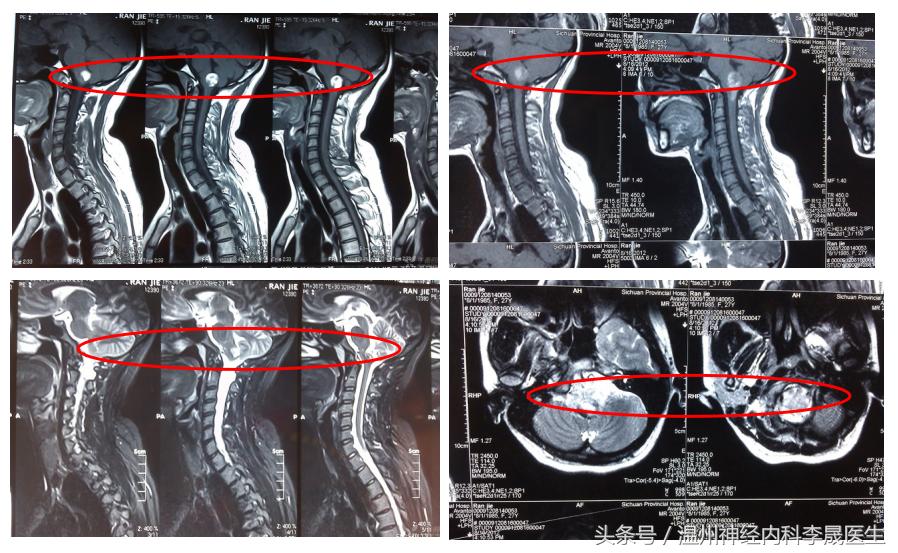 专家讲解中医治疗脑出血视频,医生对脑出血病人的治疗