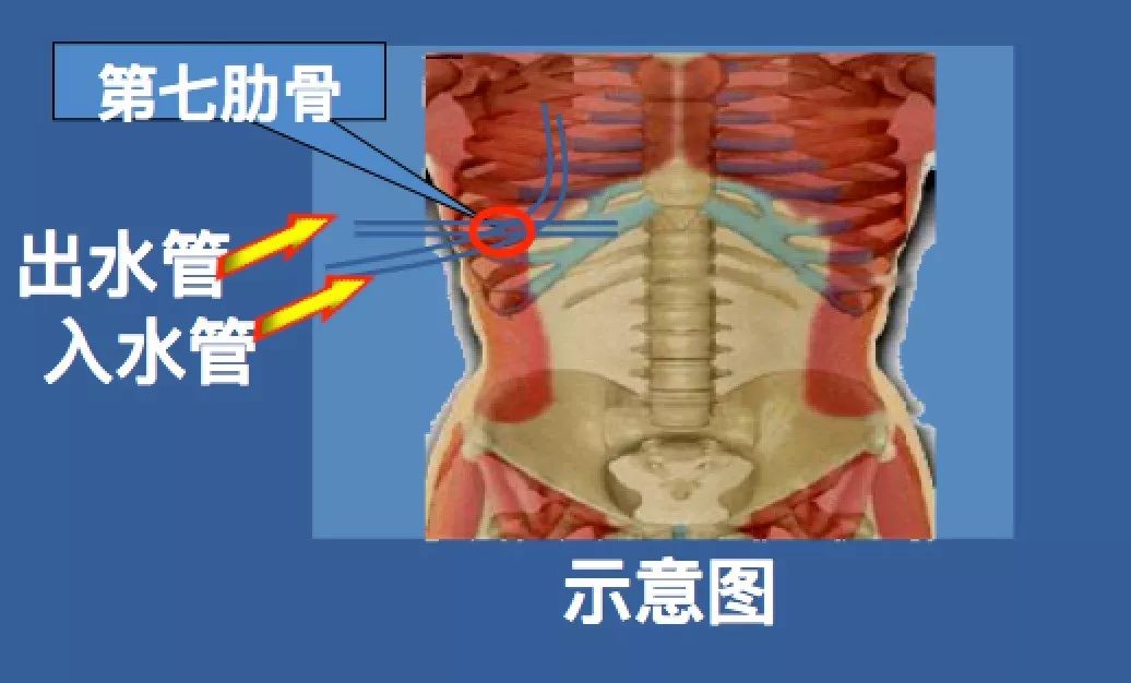 胸腔洗个“热水澡”,恶性胸水全没了
