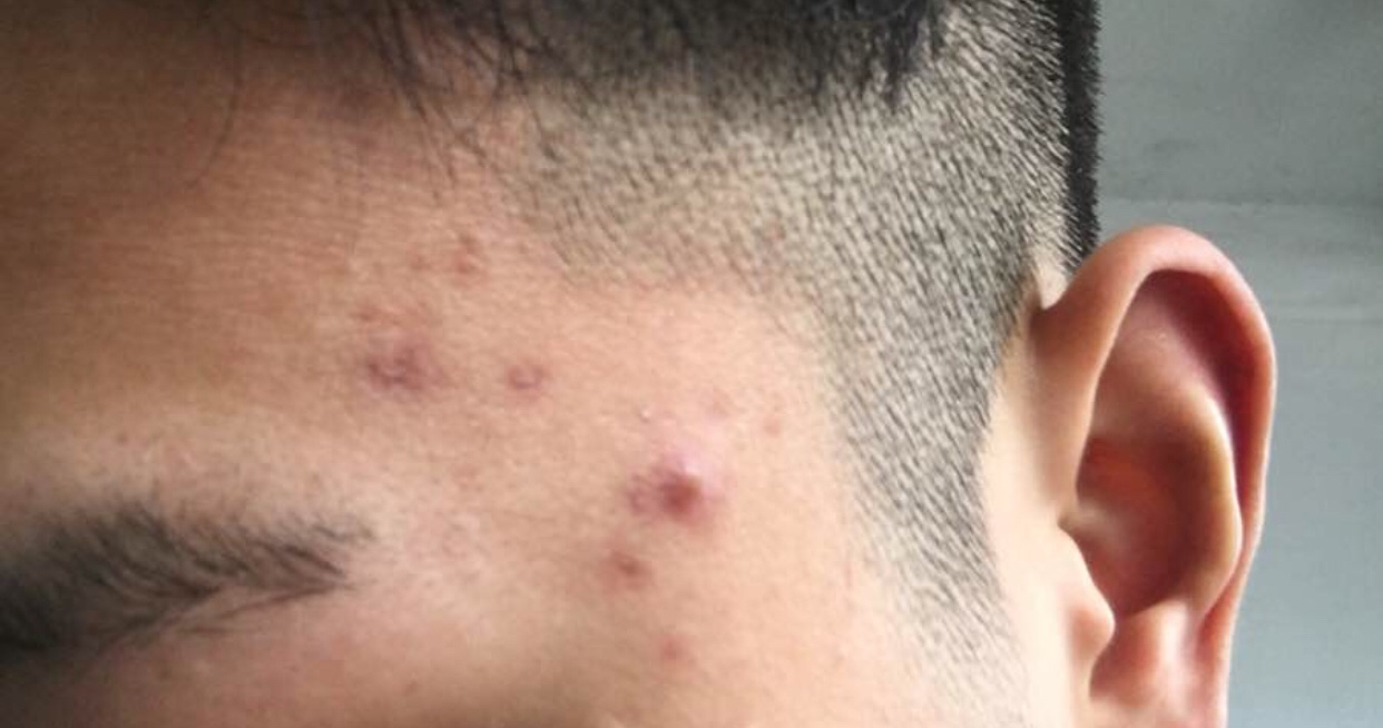 还在为长痘而烦恼吗,脸上长痘一招帮你远离痘痘肌