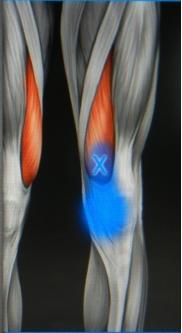 肌筋膜触发点是痛点么,筋膜球能疏通激痛点吗