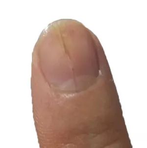 怎么从指甲上看健康图解,从指甲看疾病的图片说明