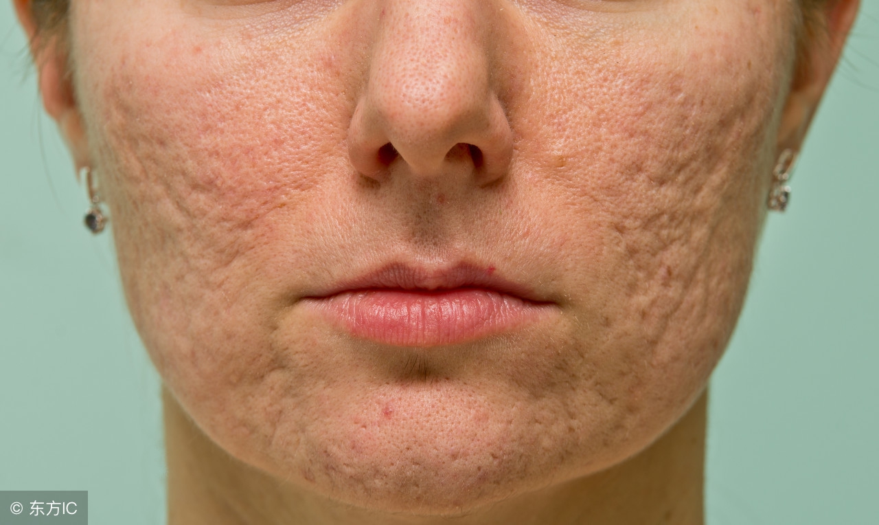 毛孔粗大显老怎么办,毛孔粗大显老10岁三招教你改善