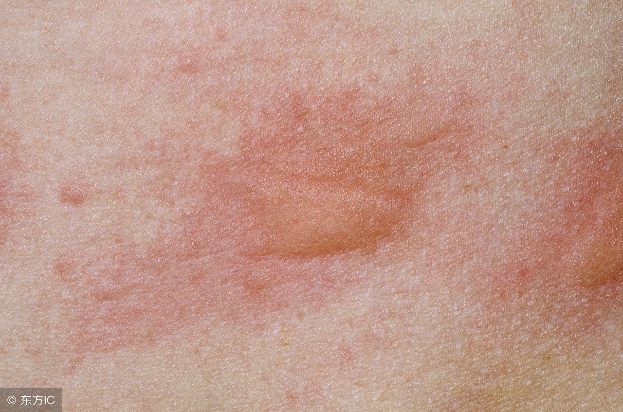 手足口水痘猩红热都得过,幼儿急疹猩红热水痘手足口鉴别