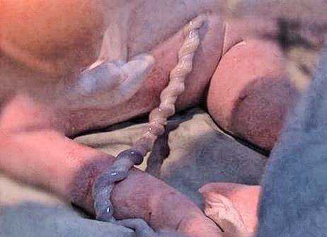 怎么预防胎儿脐带扭转,脐带扭转的概率和预防