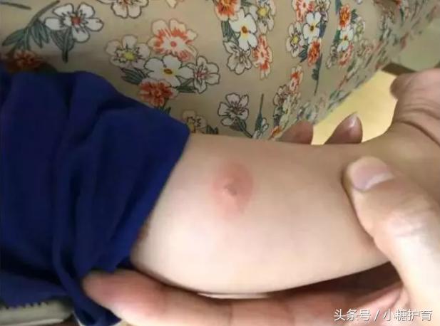 小孩皮肤红肿瘙痒是什么原因,小孩身体出现红肿并痒是怎么回事