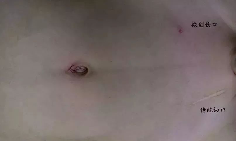 3d腹腔镜微创疝气修补术,成人疝气腹腔镜微创