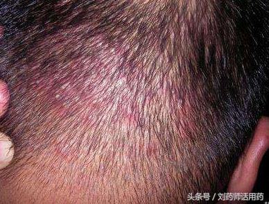 头皮毛囊炎吃哪种抗生素最有效,头皮毛囊炎口服什么抗生素最好