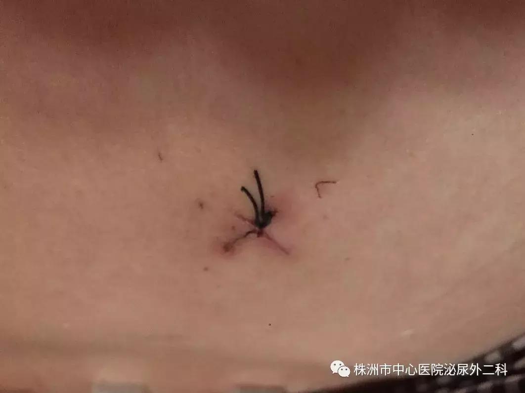 突破！无管化微创经皮肾镜取石术治疗儿童泌尿系结石