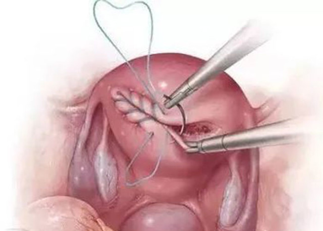 疤痕子宫可以生三胎剖宫产吗,一次剖宫产会有两道疤痕吗