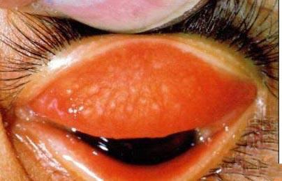 沙眼怎么治疗,沙眼严重吗有什么危害