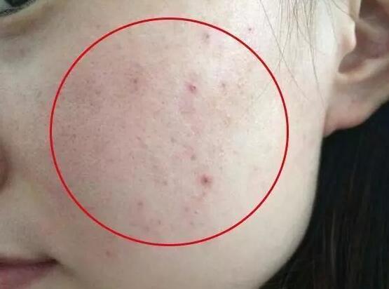 去螨虫的最佳方法脸上,脸上治疗螨虫最好的方法