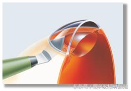 三岁宝宝散光怎么矫正,散光戴眼镜可以矫正吗