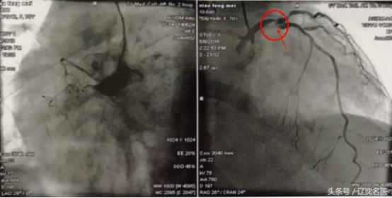 劳累后胸闷心悸是什么原因,劳累后心悸气短吃什么药