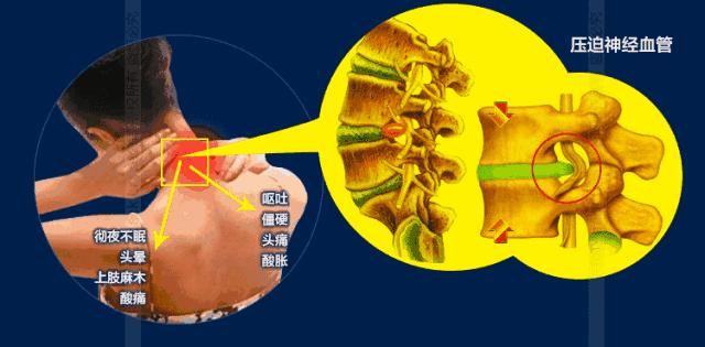 治疗关节炎的日本进口药,告别颈肩腰腿关节疼