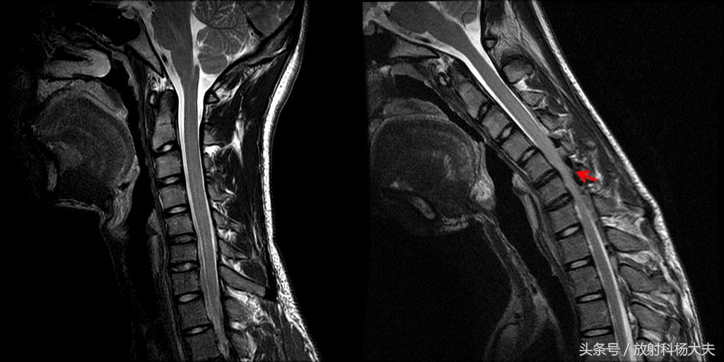 磁共振能不能看出肌肉萎缩,颈椎磁共振能不能看到茎突