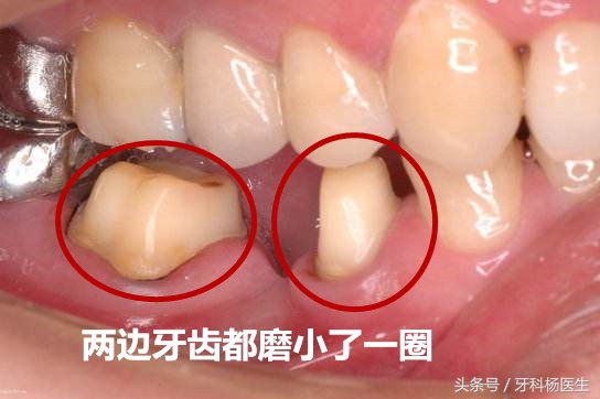 牙根没了镶一颗牙大概多少钱,拔一颗牙再补一颗假牙需要多少钱