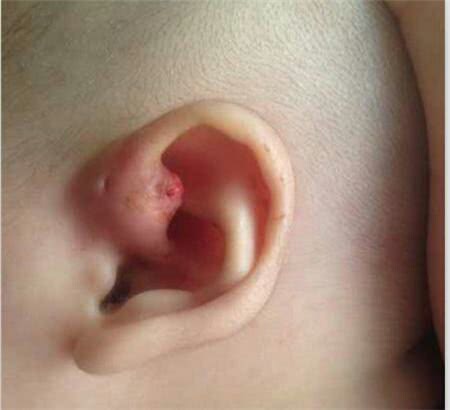 孩子耳朵旁有个小洞，是福气？快看看你家孩子有没有？