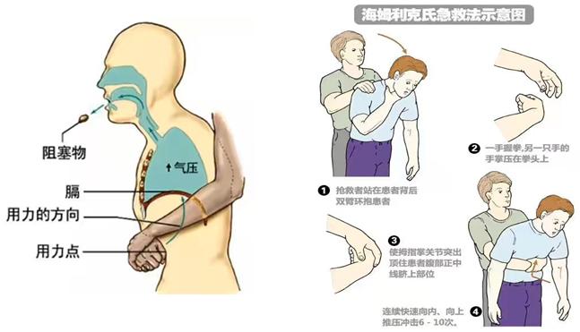 枇杷核卡入气管大爷胸闷气急险丧命医生教你一招
