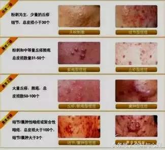 疮疡的鉴别诊断,疮疡的按诊方法