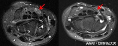 女中老年人手麻是什么原因,中年女人手麻是什么样