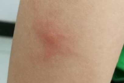 被蚊子咬了起了荨麻疹,被蚊子咬了起荨麻疹