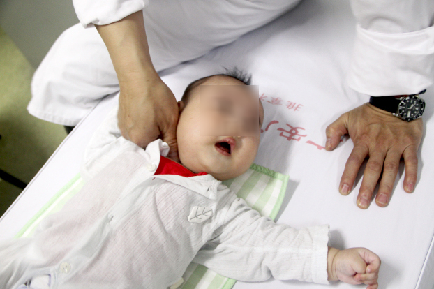 小儿斜颈推拿治疗费用能不能报销,小儿斜颈推拿治疗方法