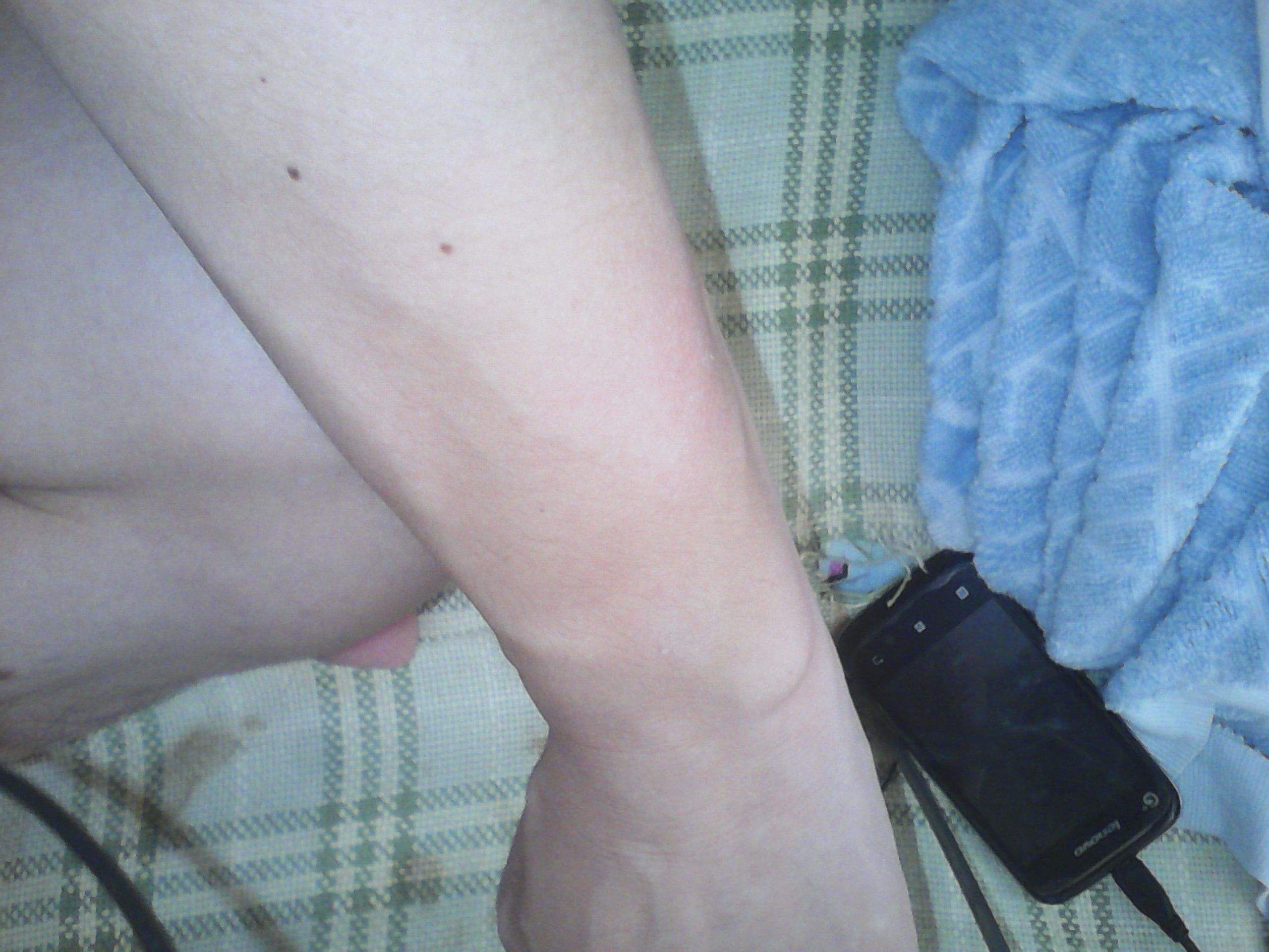 夏天湿疹最简单的自愈方法,夏天湿疹怎么治能去根