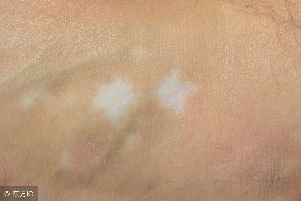 长期白癜风的真实治愈率,不治白癜风的危害