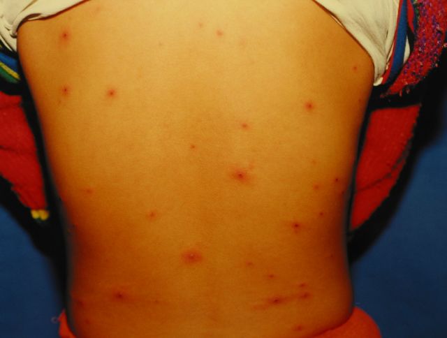 红包有不好的含义吗,额上长疱是什么原因