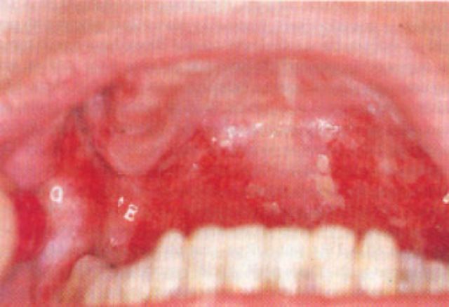红包有不好的含义吗,额上长疱是什么原因