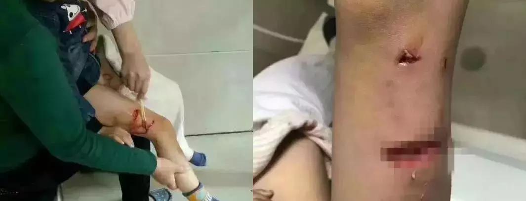 孩子被狗紧咬不放,怎样才能最快摆脱?很多人不知道!