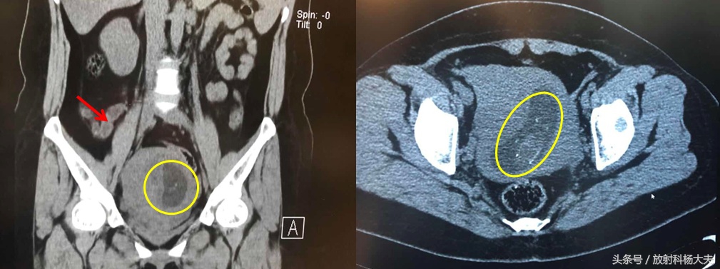 刚做完腰部ct发现怀孕了能不能要,一个月前做的ct现在怀孕有影响么