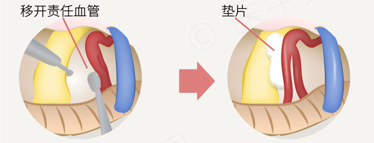 8年面肌痉挛中医能治愈吗,许振南针刀治面肌痉挛