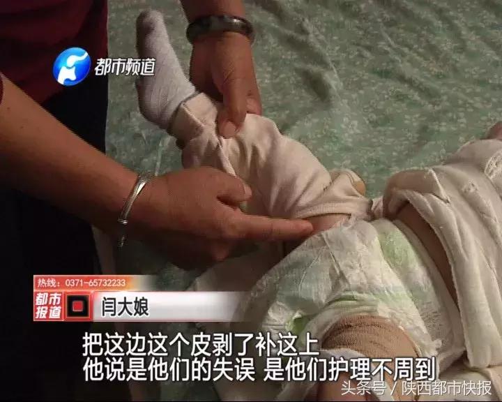 因父亲一时疏忽五岁小女孩截肢,宝宝刚出生就被截肢两只腿都没了