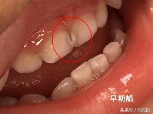 幼儿园为什么会有龋齿,小朋友为什么会有蛀牙幼儿园