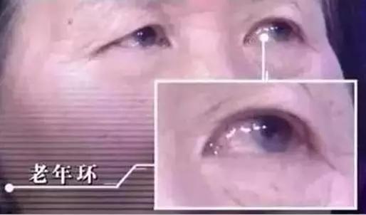 糖尿病患者要重视降胆固醇,糖尿病胆固醇高有哪些症状和危害