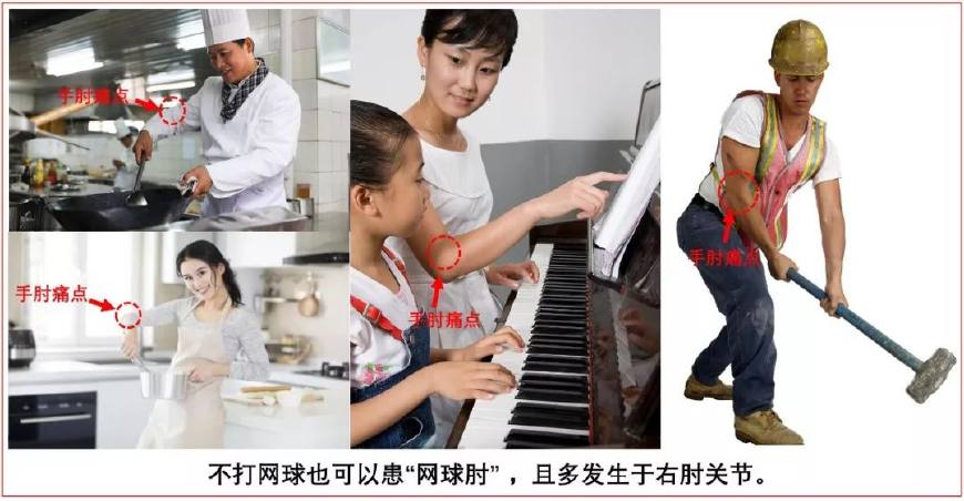 网球肘拉筋,得了网球肘如何继续网球训练