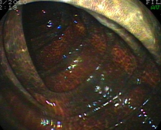 老人得结肠黑变病饮食怎么调理,结肠黑变是什么原因引起的