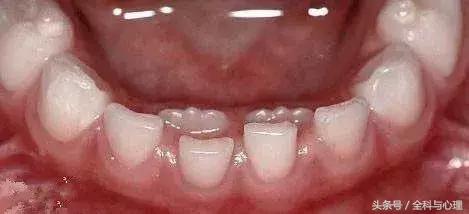 孩子帮妈妈功不可没,小孩双排牙最佳解决方法