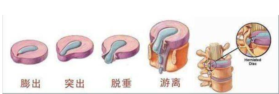 腰椎间盘突出有增生怎么保守治疗,腰椎间盘突出10mm还能保守治疗吗