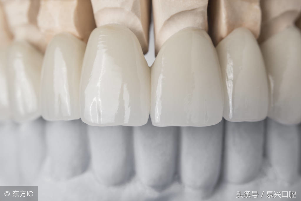 烤瓷牙的优缺点,各类烤瓷牙材料的优缺点对比