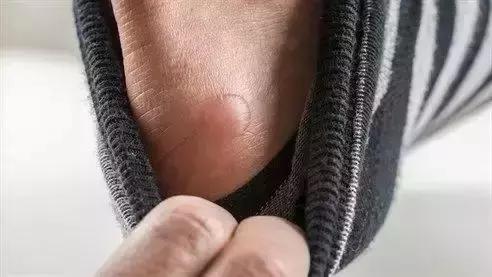 跑步脚上起血泡长什么样子,跑步大脚趾起水泡是怎么回事